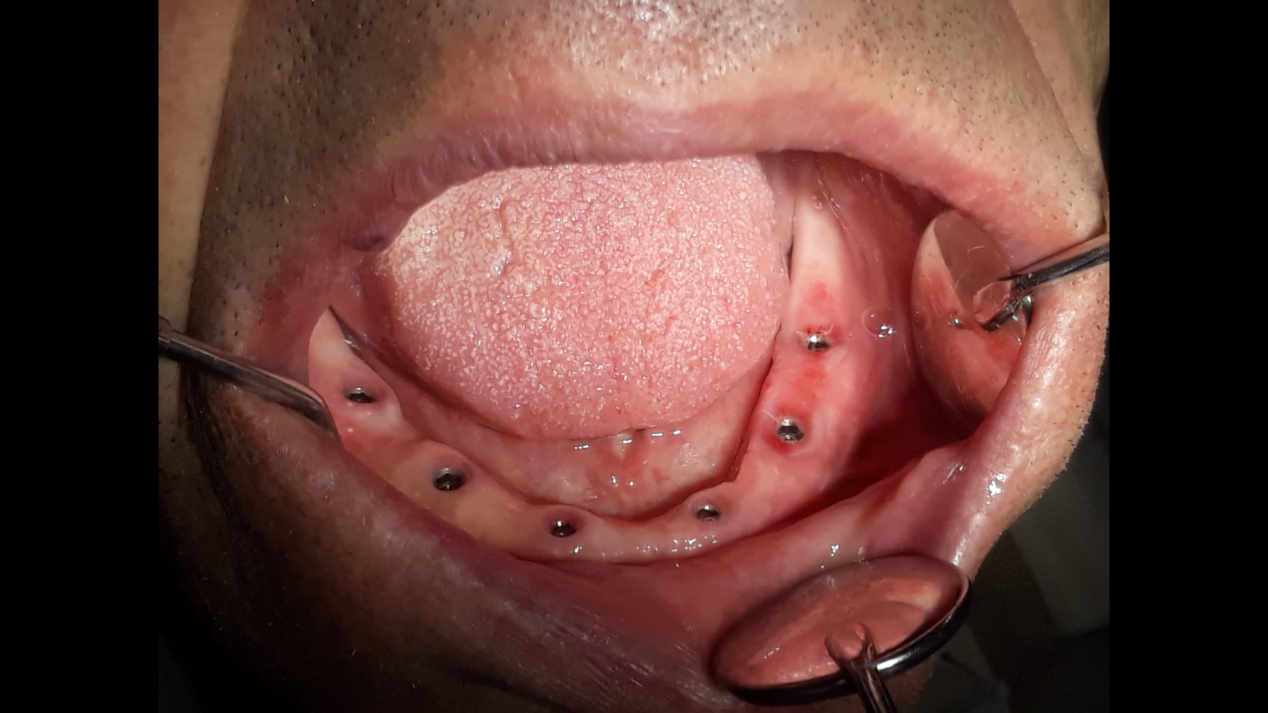 Implanturi 1
