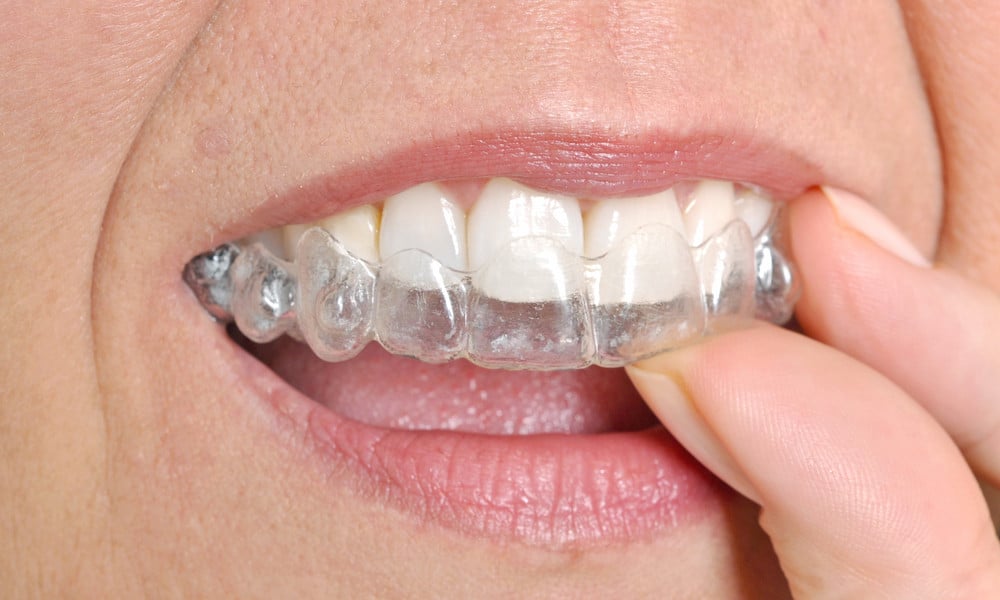 most-value-invisalign-skopek